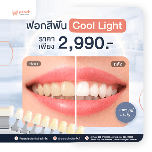 โปรโมชันฟอกสีฟันด้วยเครื่อง Cool Light ราคา 2,990 บาท พร้อมภาพเปรียบเทียบก่อนและหลัง